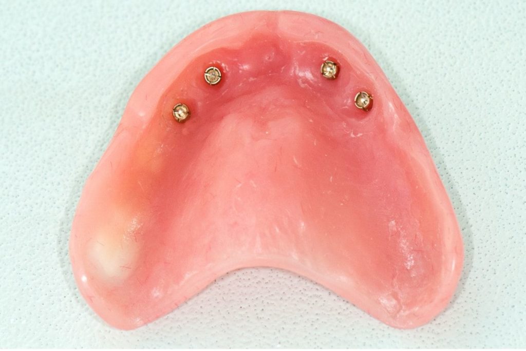 Полный зубной протез на имплантах