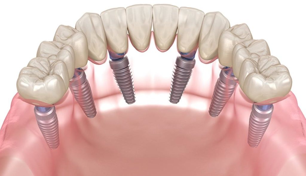 Имплантация зубов методом All-on-6
